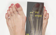 Load image into Gallery viewer, Say Goobye to Hallux Valgus Now